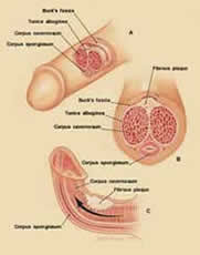 Induratio penis plastica (IPP). Induratio penis plastica (IPP).